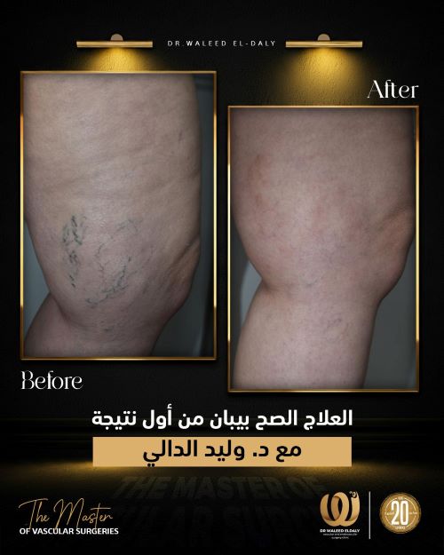 ما هي دوالي الساقين